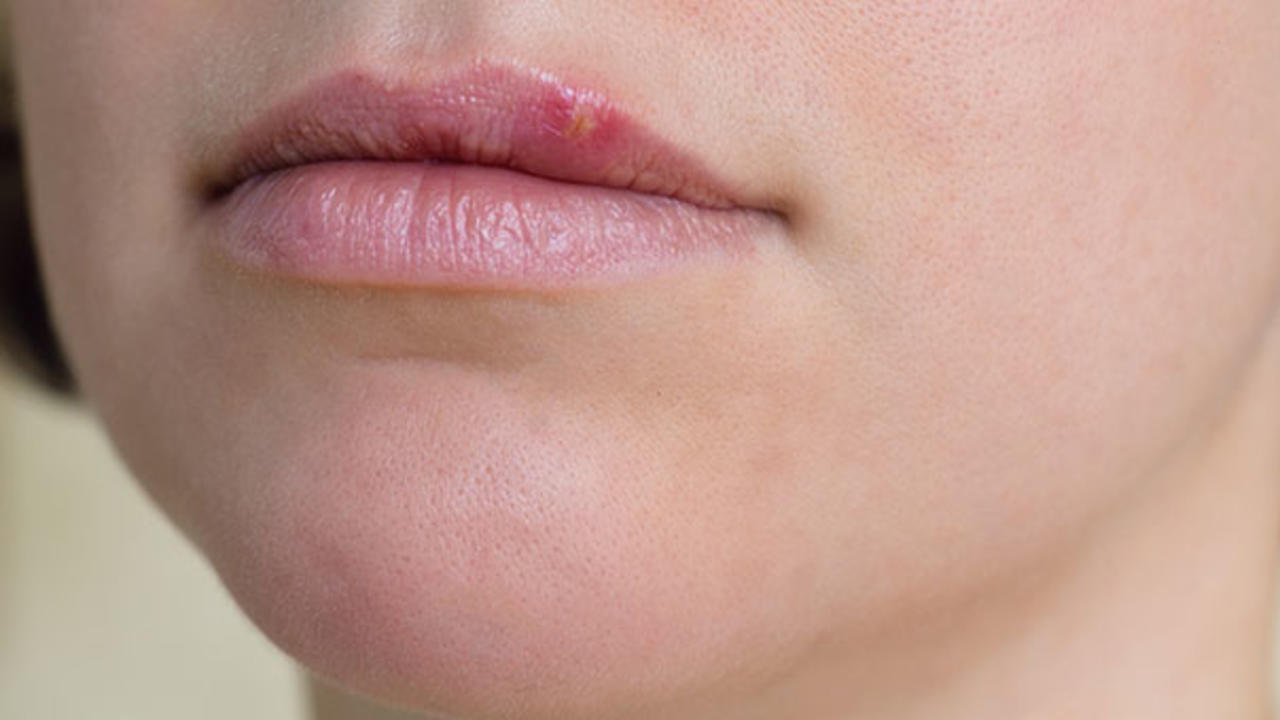 Everything You Think You Know About Herpes Is Wrong