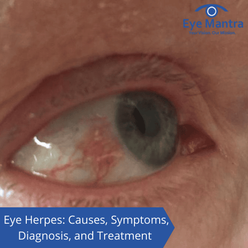 Eye Herpes: Causes, Symptoms, Diagnosis, and Treatment