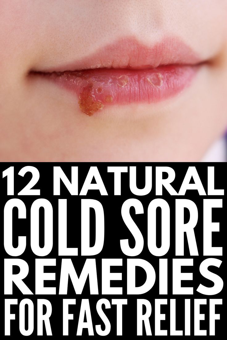 Fast and Effective: 12 Natural Cold Sore Remedies that Work