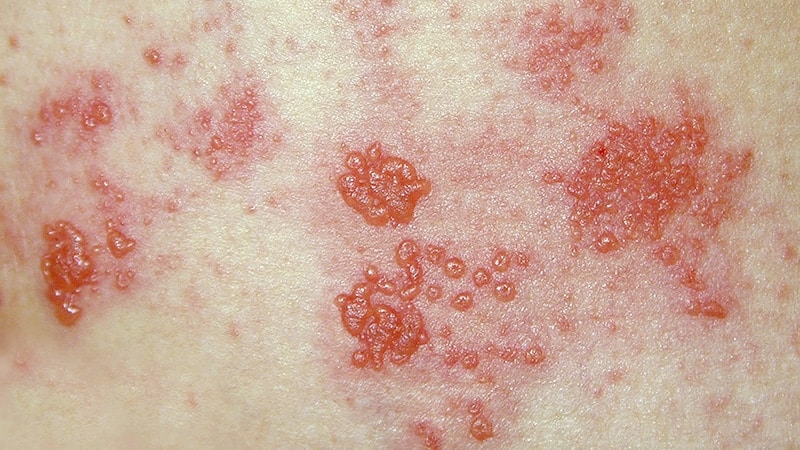 Fast Five Quiz: Herpes Zoster Postherpetic Neuralgia