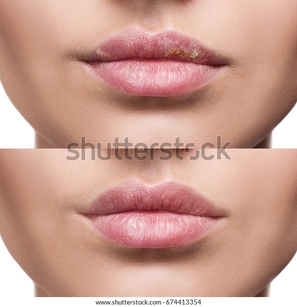 Female Lips Herpes Sore Before After Stock Photo (Edit Now) 674413354