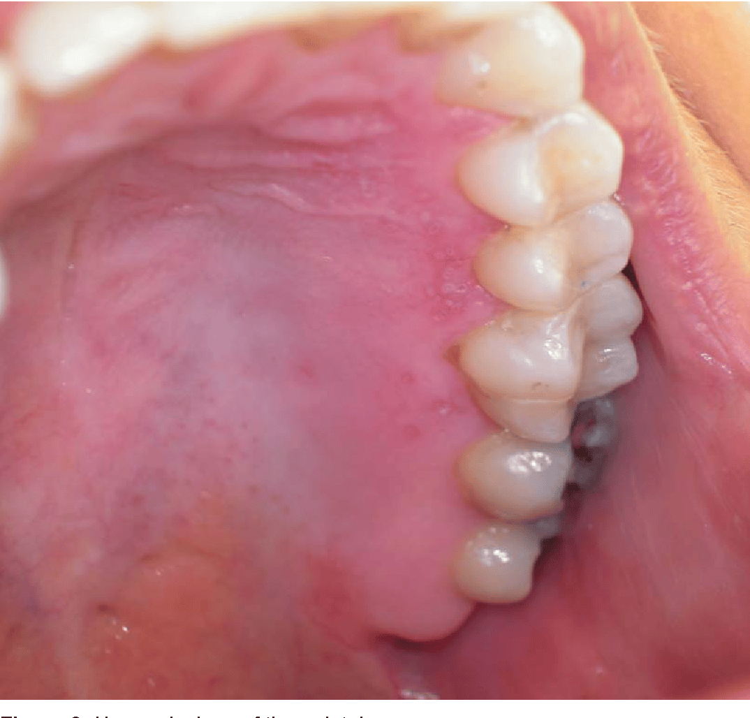 Figure 3 from HERPES SIMPLEX VIRUS (HSV) INFECTION OF THE MOUTH ...