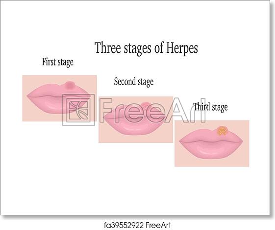 Free art print of Herpes on the lips. The three stages of herpes ...