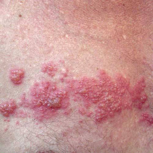 Genital Herpes â Infection, Symptoms And Other Causes
