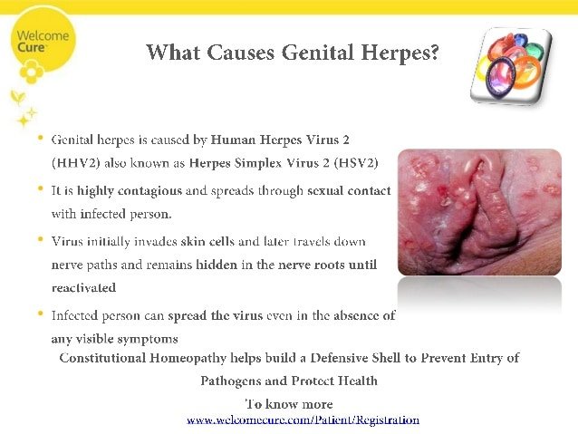 Genital Herpes: Causes, Symptoms, Complications and its ...