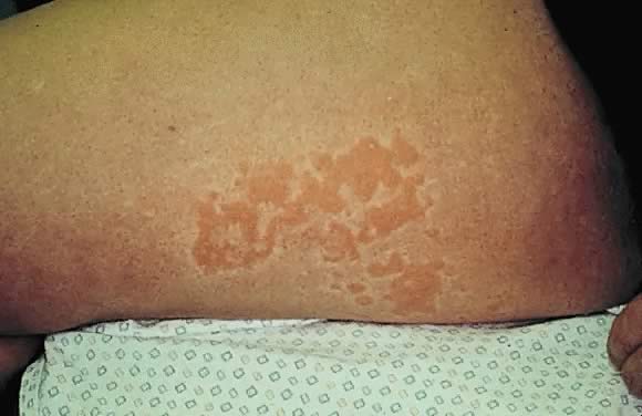 genital herpes on thigh