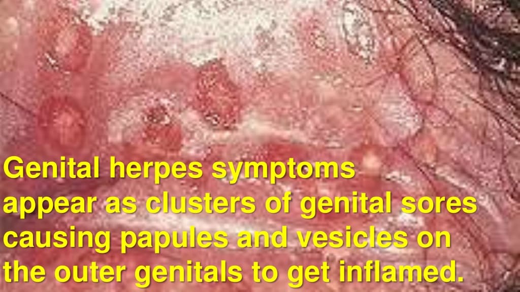 Genital Herpes Symptoms and Herpes Treatment