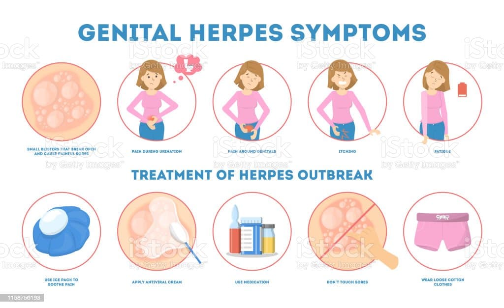 Genital Herpes Symptoms Infectious Dermatology Stock Illustration ...
