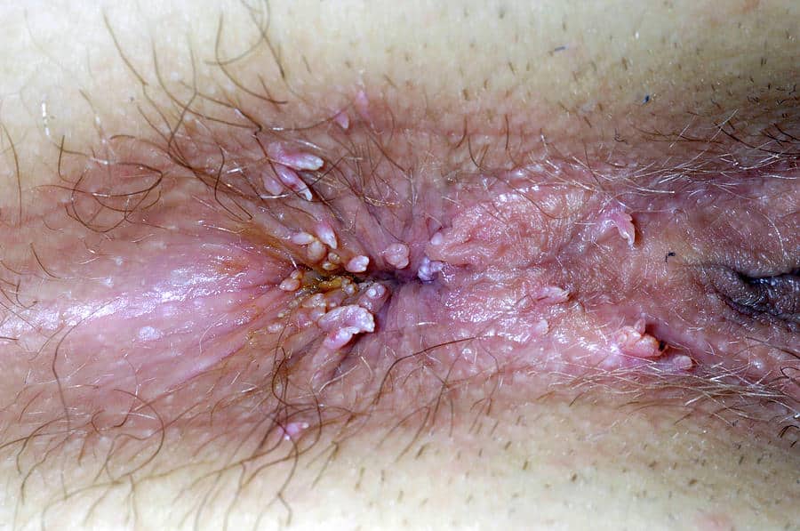 Genital Warts Photograph by Dr P. Marazzi/science Photo Library