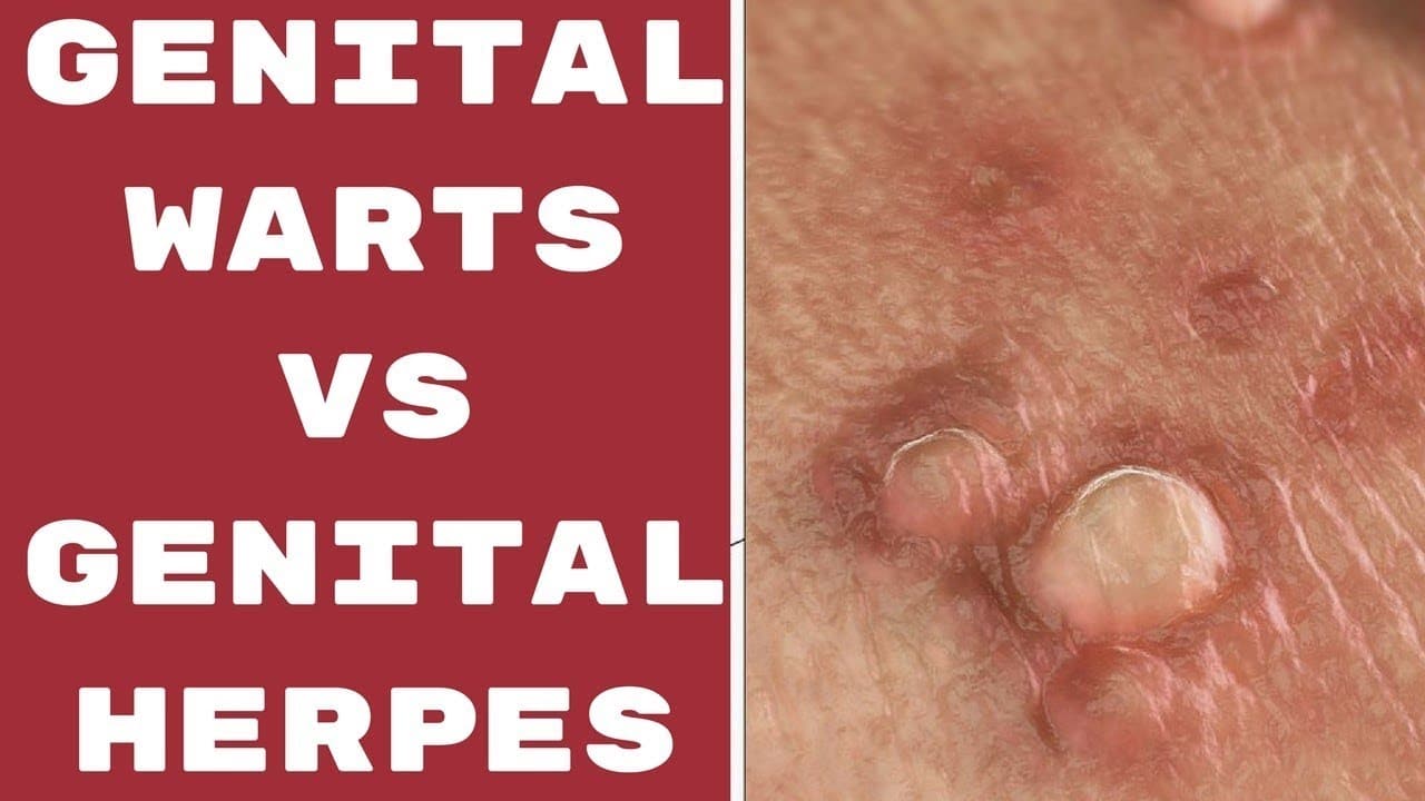 Genital Warts Vs Genital Herpes