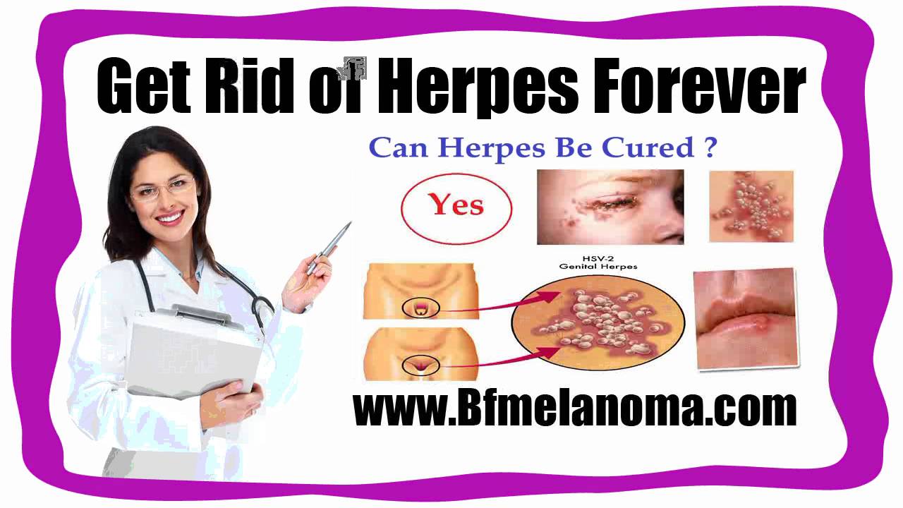 Get Rid of Herpes Forever
