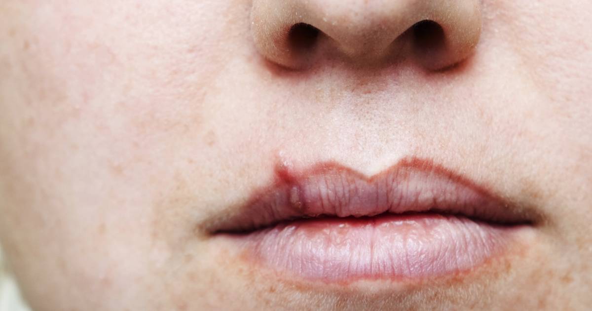 Half of Americans have cold sore virus  12 percent genital herpes