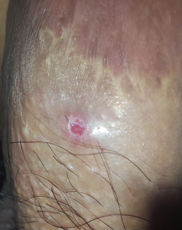 Has Penile Shaft Ulcer. Skin Cancer or STD or Bacterial Infection ...