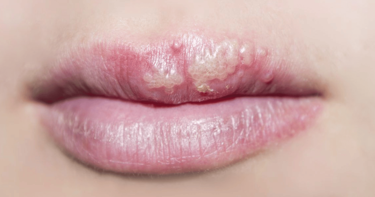 Heal a HERPES COLD SORE IN Just 2 Days