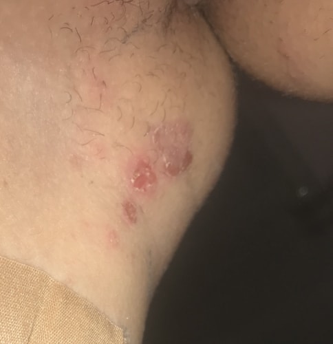 Help! Dont know if this is herpes or contact dermatitis?