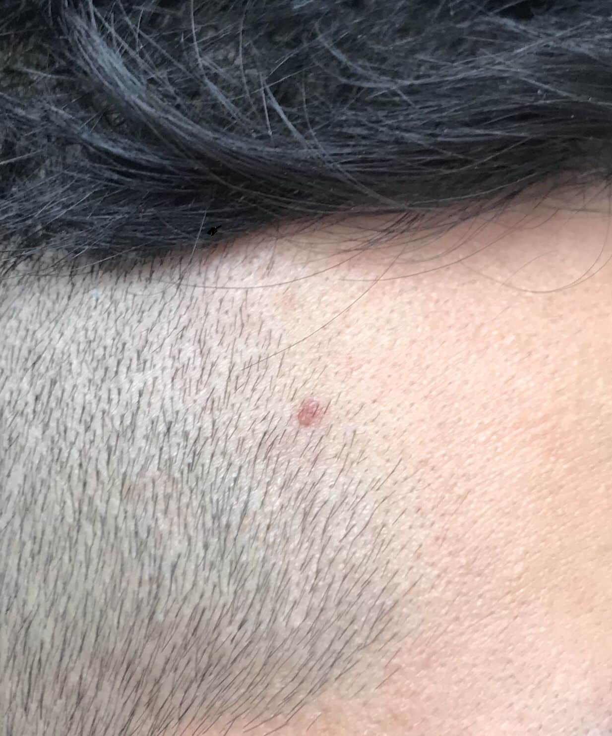 Help guys ! Is this a blind pimple? Herpes ? Will it go away ...