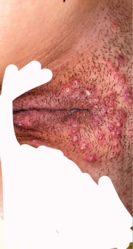 HELP IMPORTANT!!! herpes?
