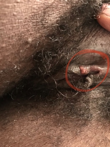 HELP!! Is this genital herpes or something else? **PICS INCLUDED ...