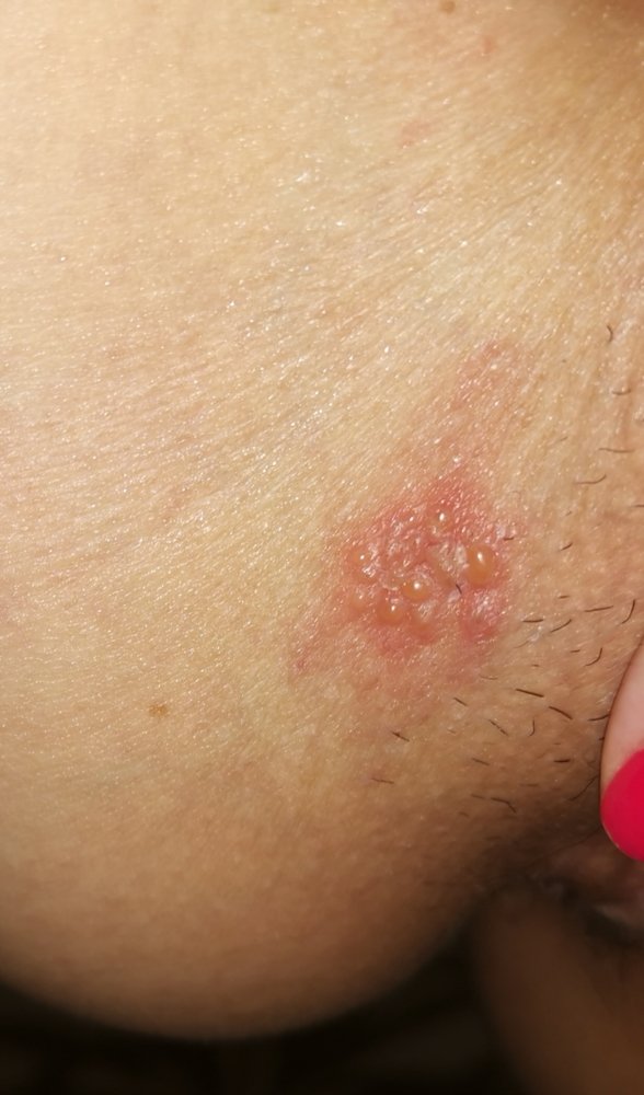 Help! Is this herpes? Blister outbreak