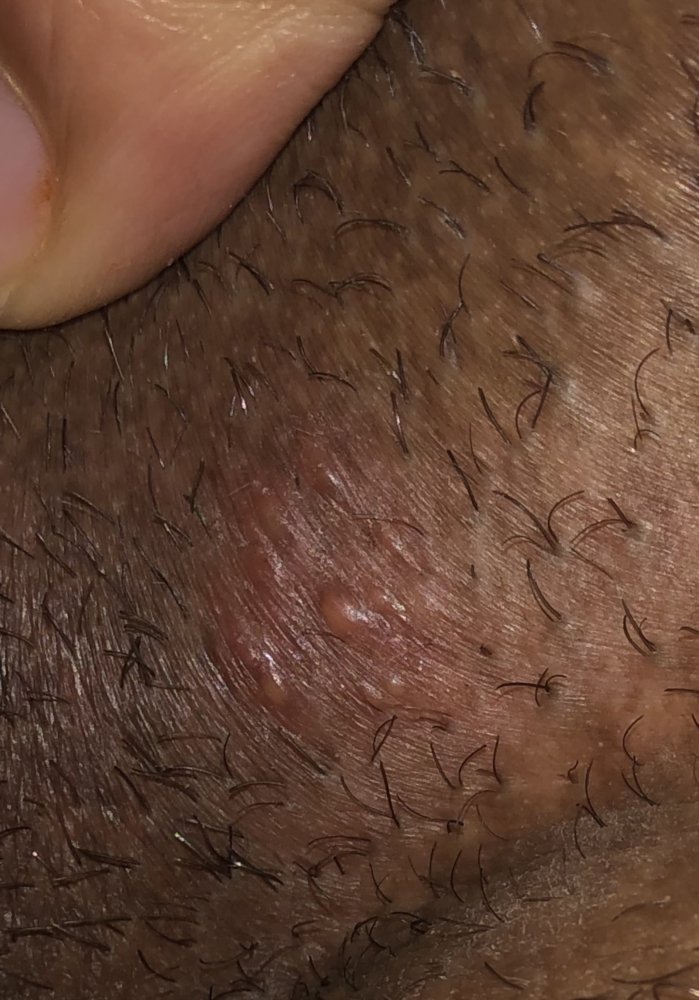 Help is this herpes? It doesnt itch burn or hurt