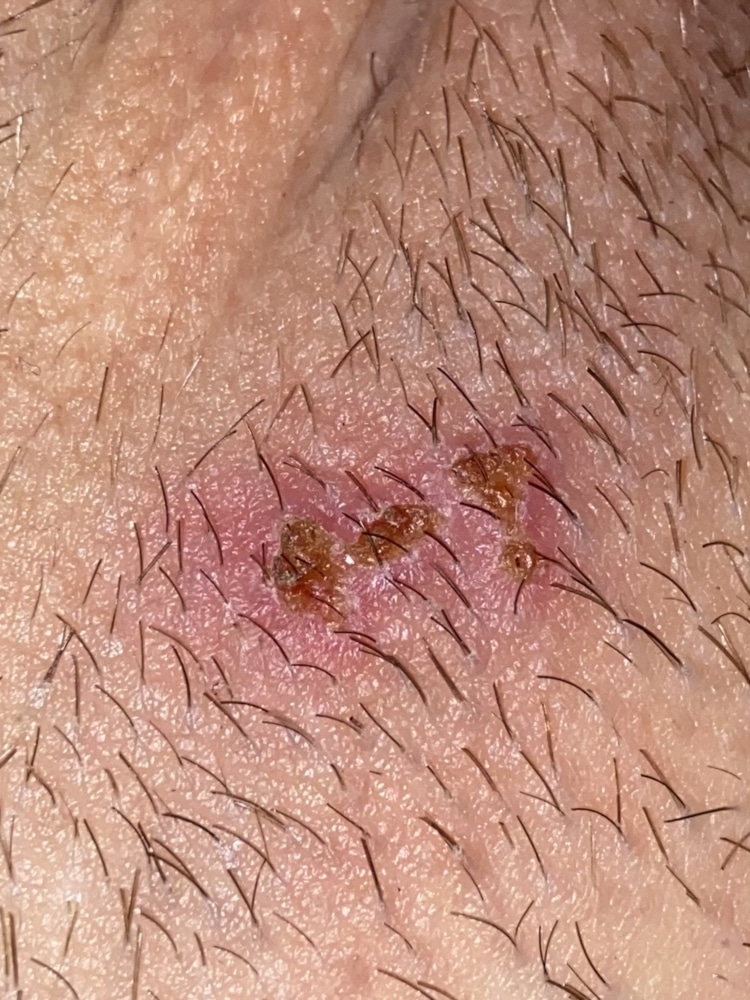 Help please ! Is this herpes ? Photo included