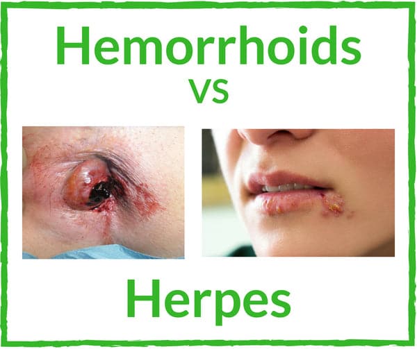 Hemorrhoids  Page 2
