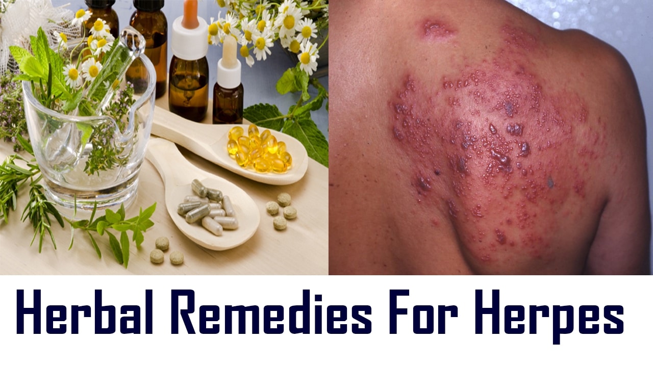 Herbal Remedies For Herpes
