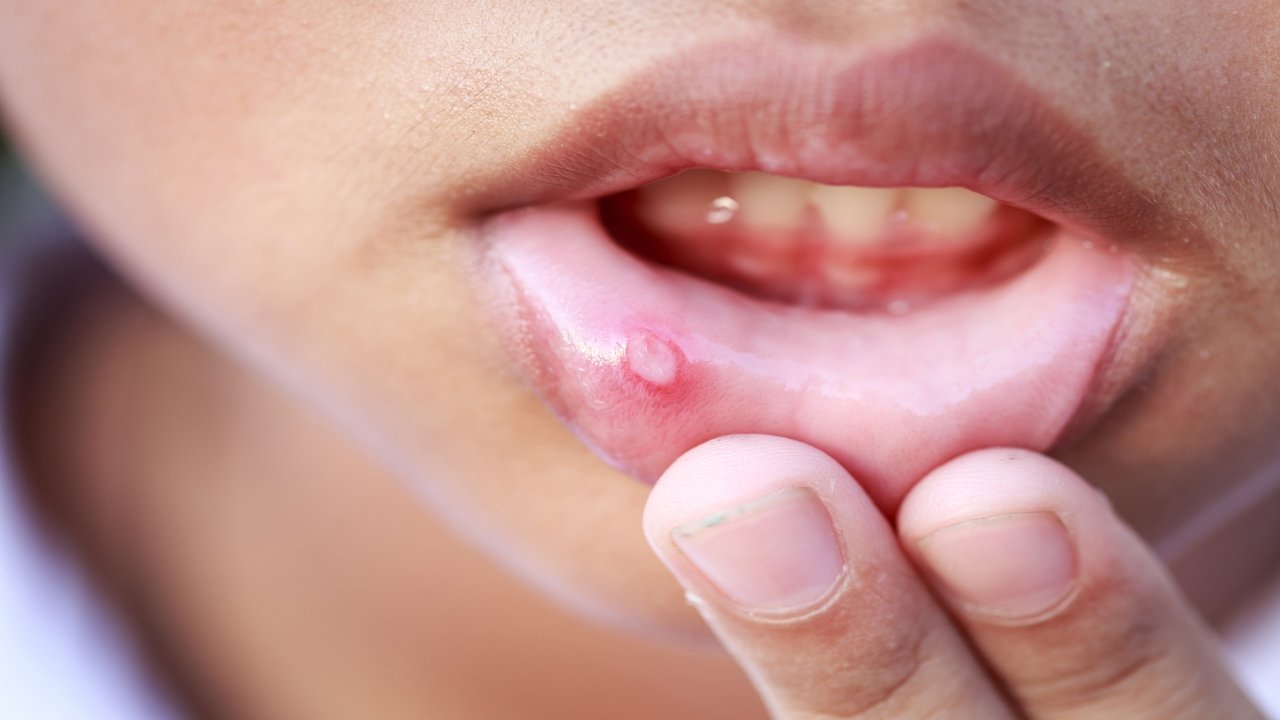 Herpes: causes, symptoms, prevention and treatment