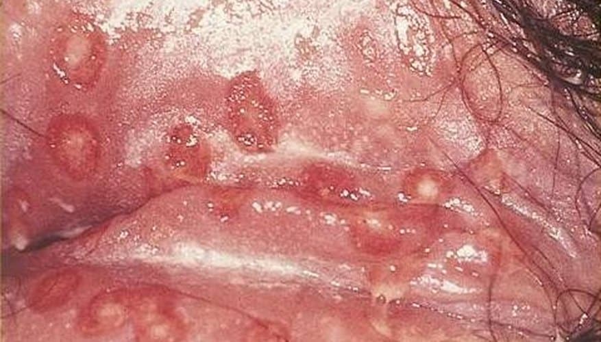 Herpes Cyst Symptoms