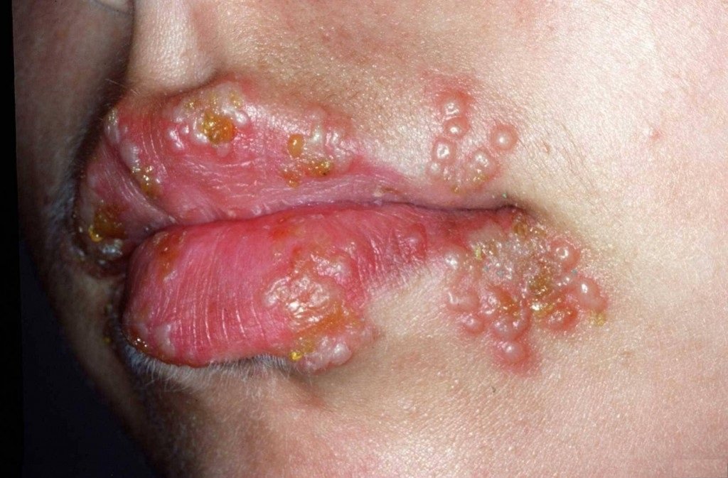 Herpes Facts Everyone Should Know