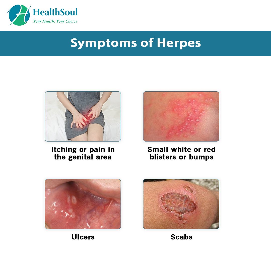 Herpes Genitalis: Symptoms and Treatment