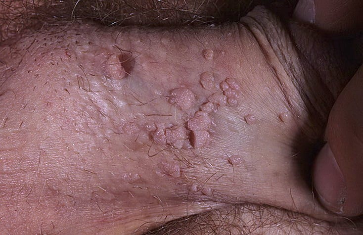 Herpes in Men Pictures  30 Photos &  Images / illnessee.com