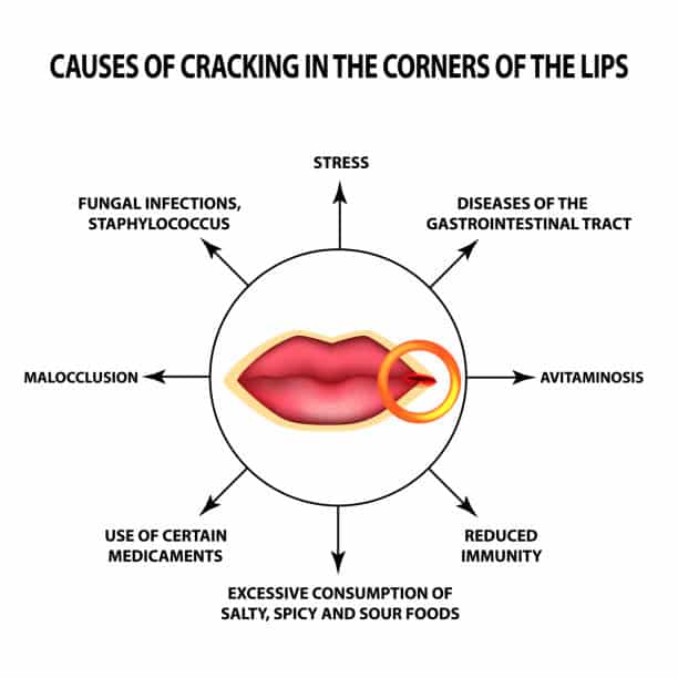 Herpes In The Mouth Background Illustrations, Royalty