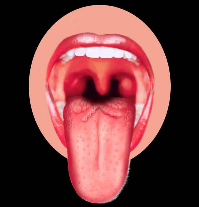 Herpes in the tongue. Causes and treatment of the disease