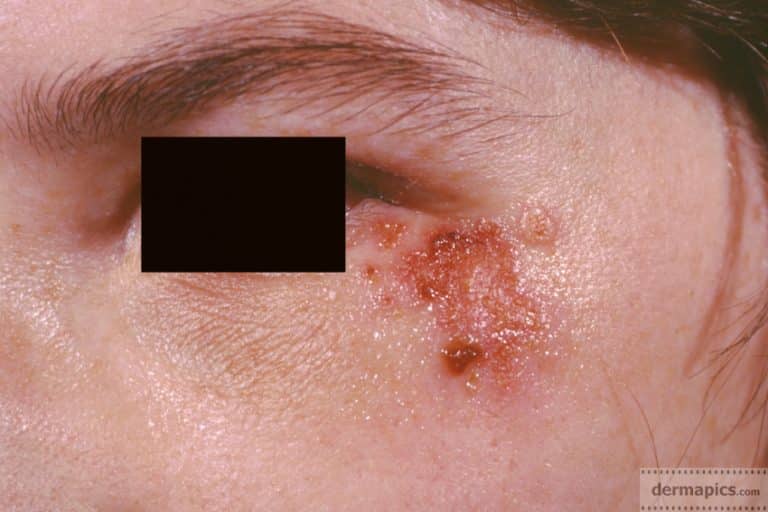 HERPES infection