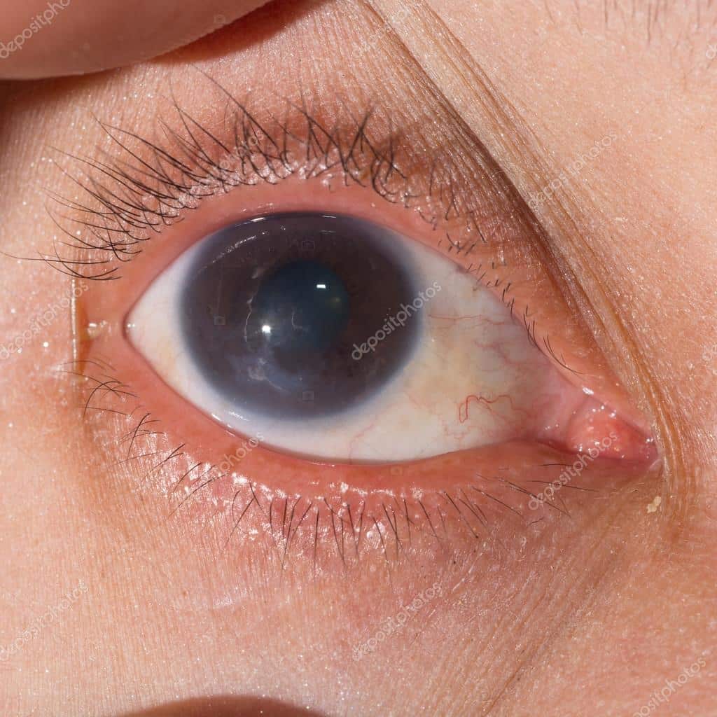 Herpes keratitis at eye test â Stock Photo Â© arztsamui #106589154