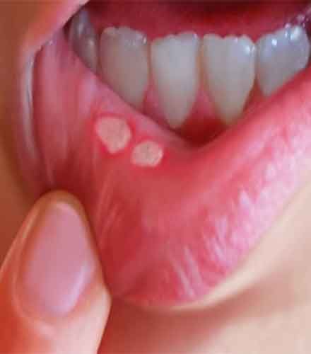 Herpes Mouth Sores Home Remedies â Herpes Free Me