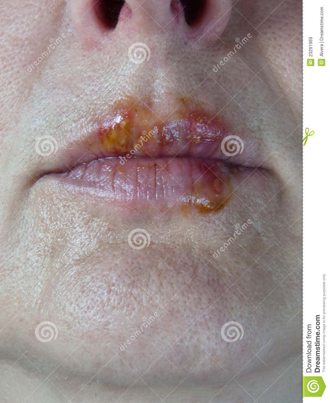 Herpes Mouth Sores Lips Virus Stock Image