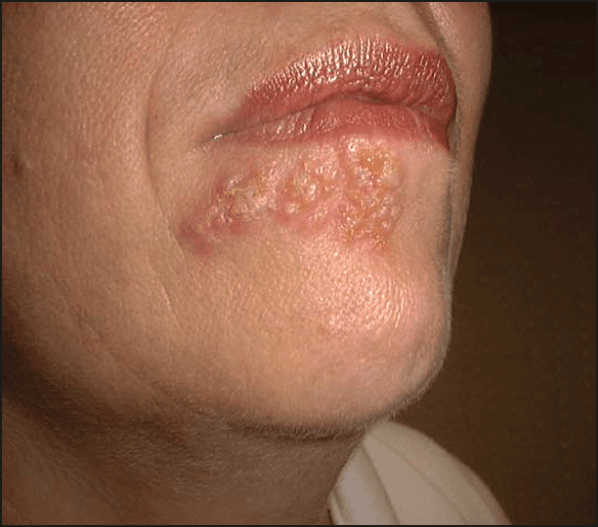 Herpes On Face Treatment