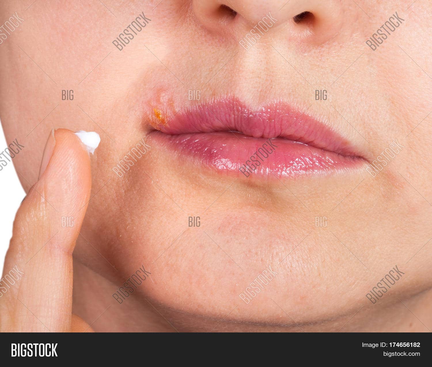 Herpes On Lip Close