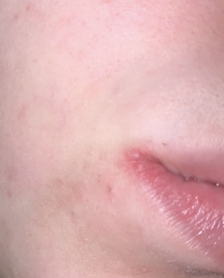 Herpes on mouth?