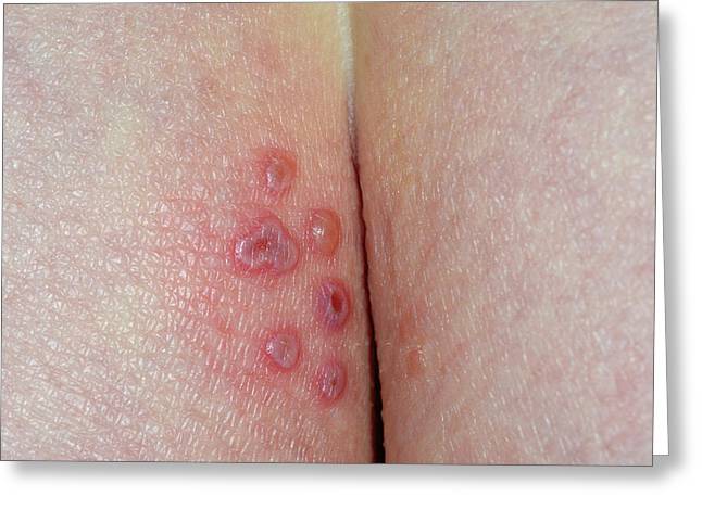 Herpes On The Buttocks Photograph by Dr P. Marazzi/science Photo Library