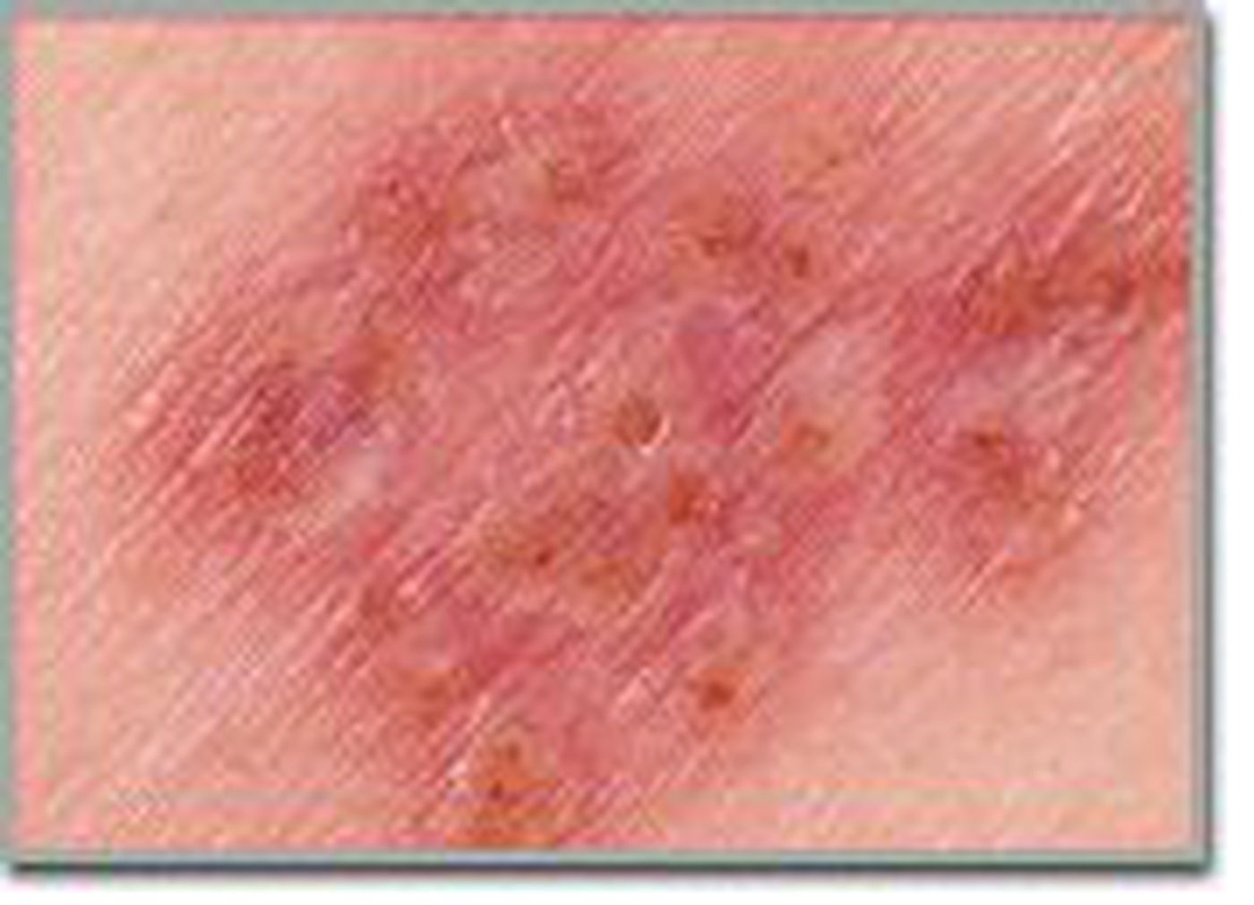Herpes one of the most common STD