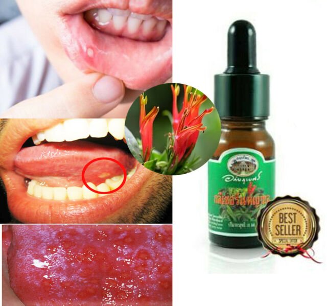 Herpes Oral Aphthous Ulcers Treatment Natural Drop Ayurvedic Product