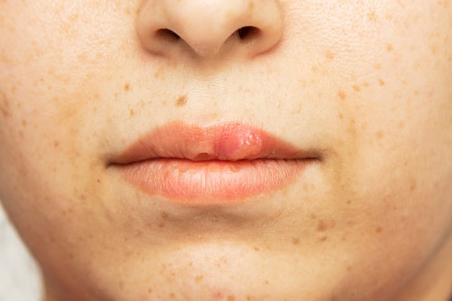 Herpes Oral Cold Sore Blisters On The Lips Herpes Simplex Stock Photo ...