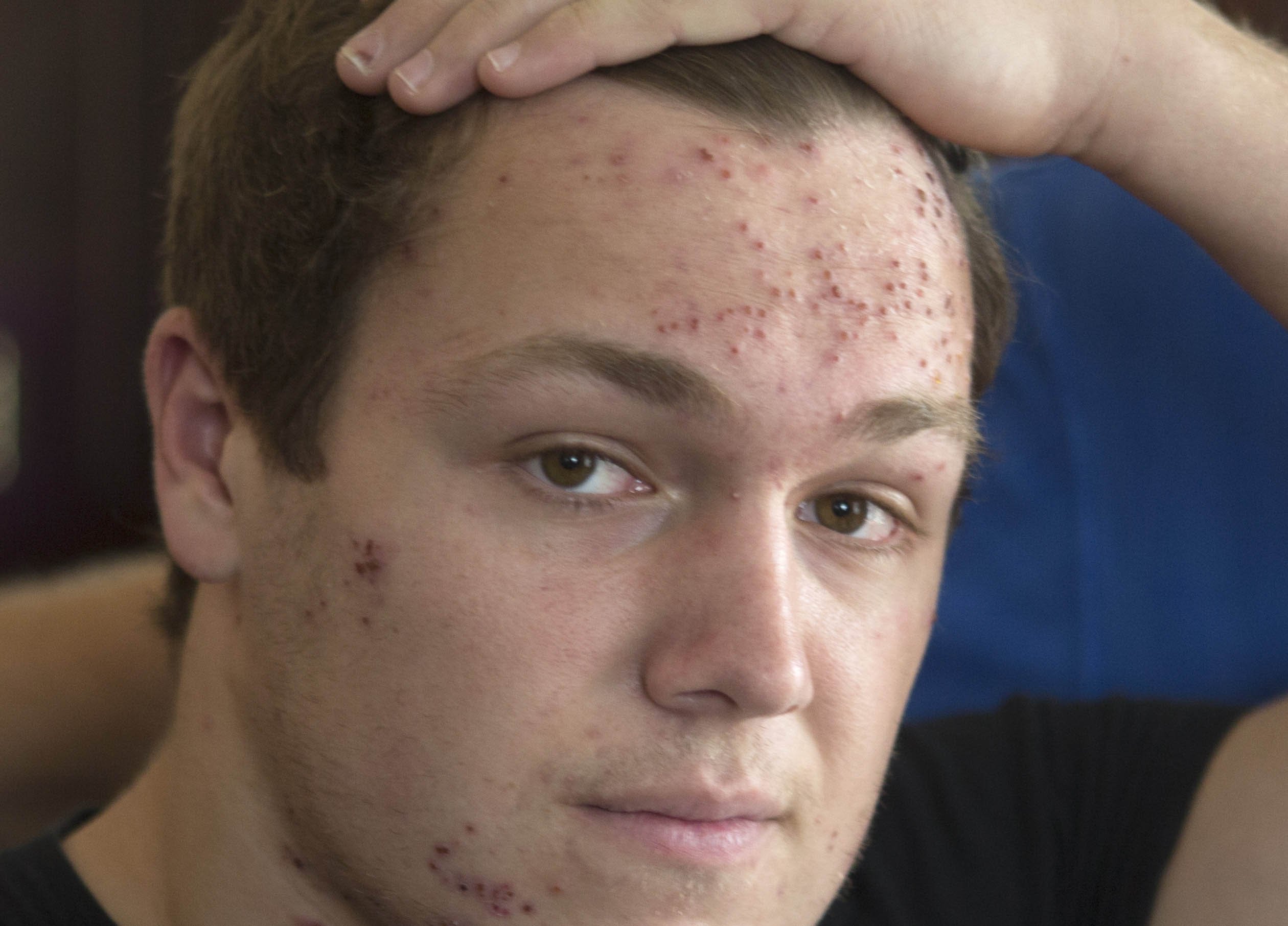 Herpes Rash On Face Pictures