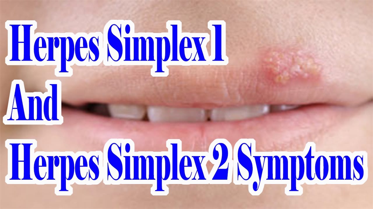 Herpes Simplex 1 And 2 Symptoms : Which Herpes You Are Suffering From ...
