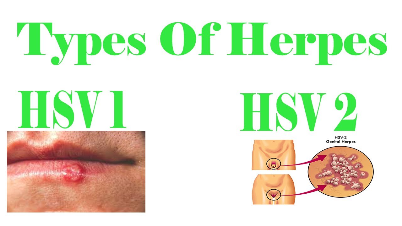 Herpes Simplex 1 Genital Area Symptoms  Herpes Free Me