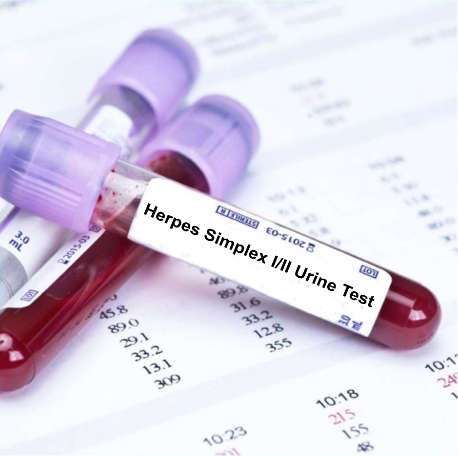Herpes Simplex I/II Urine Test