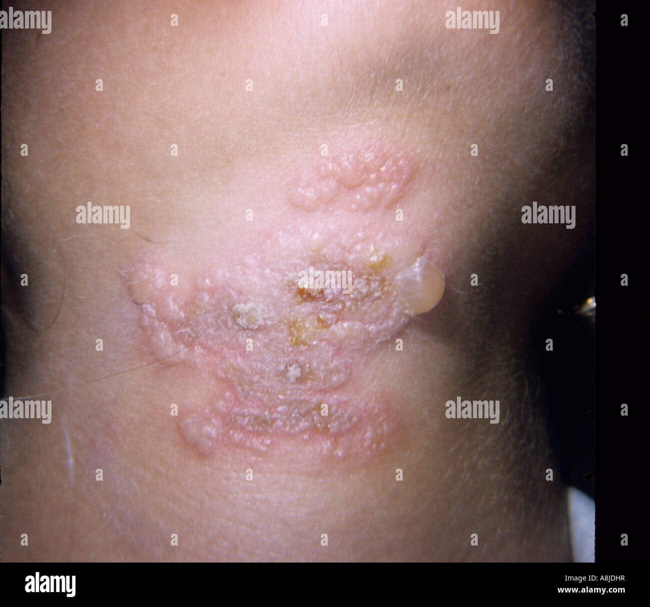 Herpes simplex rash on the patient